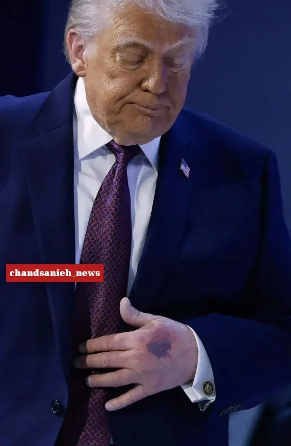 تصویری خبرساز از وضعیت عجیب دست دونالد ترامپ