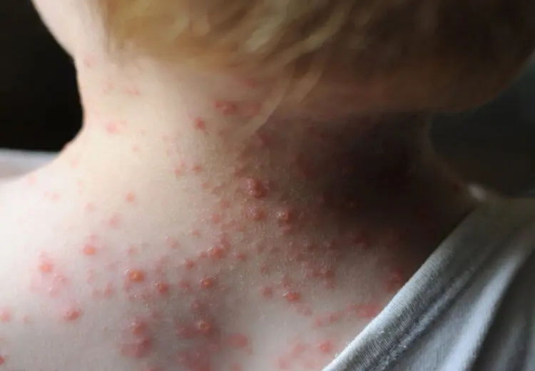 علت شیوع آبله مرغان در ایران چیست؟