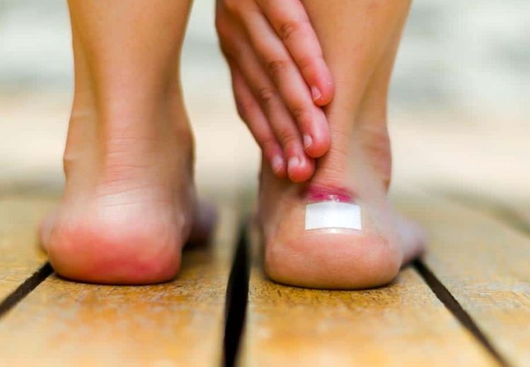 روش درمان تاول پا بر اثر پیاده‌روی/ چگونه از ایجاد تاول در پاها جلوگیری کنیم؟