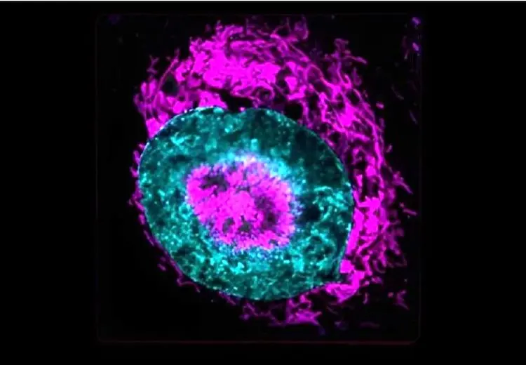 جزییات غربالگری ۳ سرطان شایع در ایران