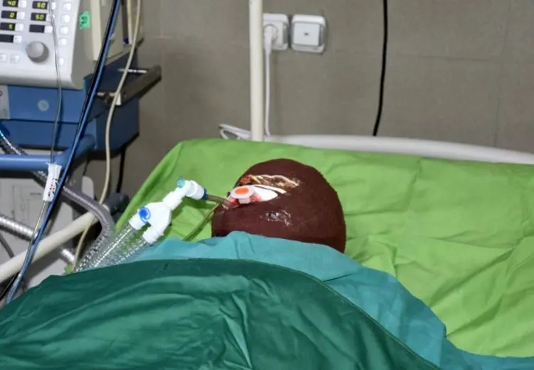 اسیدپاشی مرد همسایه روی پدر و دختر 