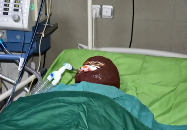 اسیدپاشی مرد همسایه روی پدر و دختر 