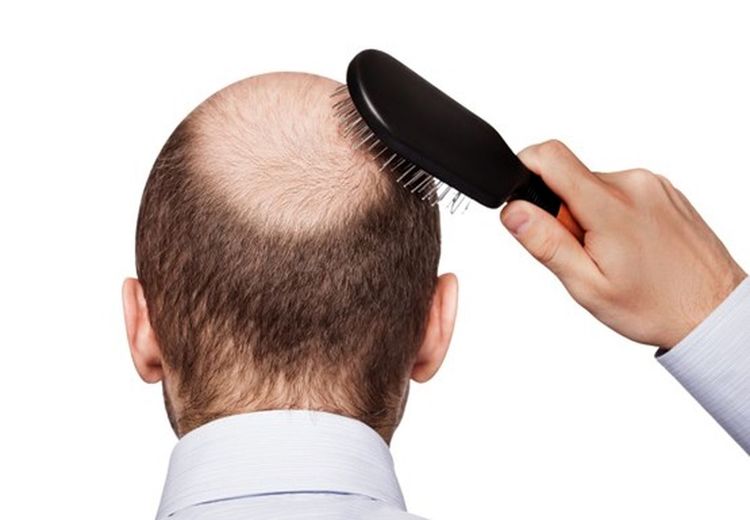 عوامل مهم ریزش مو رو بشناسید