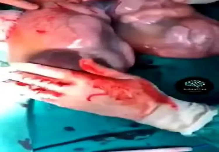 لحظه به دنیاآمدن دوقلوها با کیسه آب