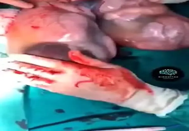 لحظه به دنیاآمدن دوقلوها با کیسه آب