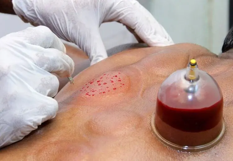چه کسانی نباید در فصل بهار حجامت کنند؟