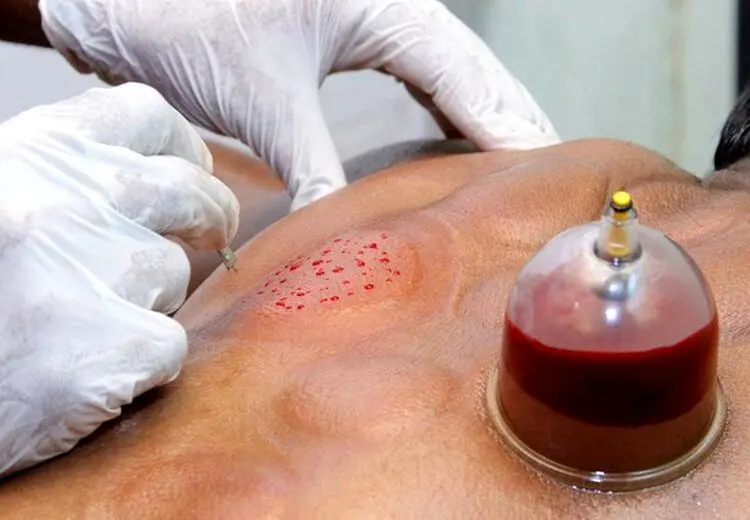 چه کسانی نباید در فصل بهار حجامت کنند؟