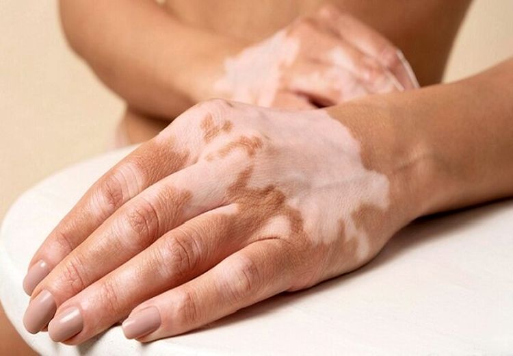 تازه‌ترین توصیه‌های پزشکی درباره پیسی یا لک‌های پوستی