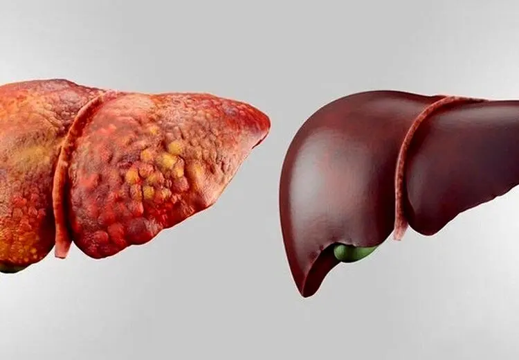 چرا کبد چرب خطرناک است؟ / راه‌های پیشگیری از کبد چرب