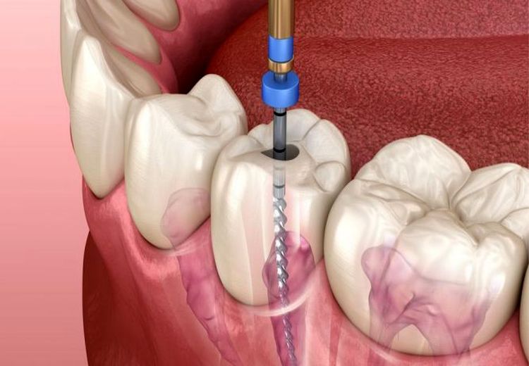 دندان عصب کشی شده چه مدت زنده می ماند؟