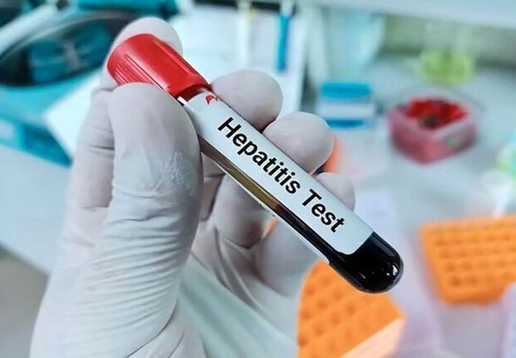 هشدار شیوع بالای هپاتیت A در کودکان و نوجوانان ایرانی