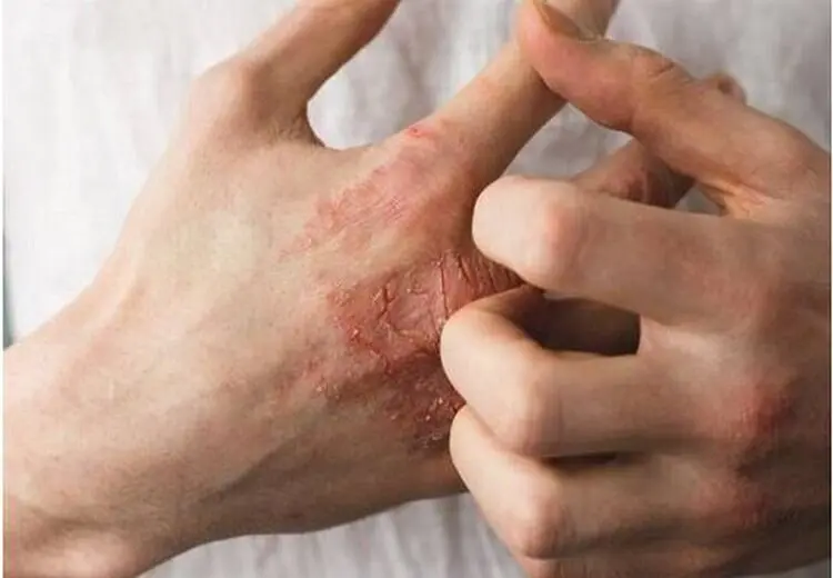 بیماری‌ای که اضطراب آن را تشدید می‌کند