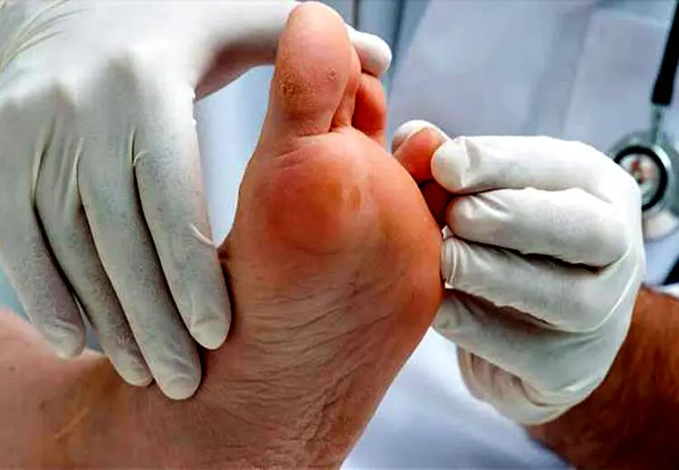 مراقبت های درمانی برای بیماران زخم پای دیابتی
