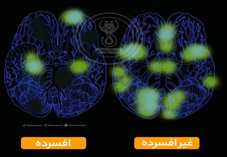 تاثیر افسردگی بر مغز 