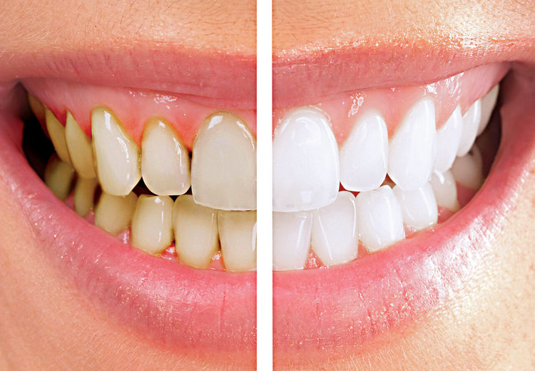 چطور دندان‌هایی صدفی و سفید داشته باشیم؟