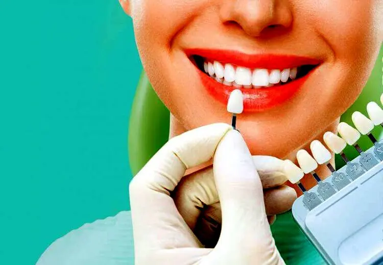 چگونه از لمینت و کامپوزیت دندان مراقبت کنیم؟ + باید ها و نباید ها
​