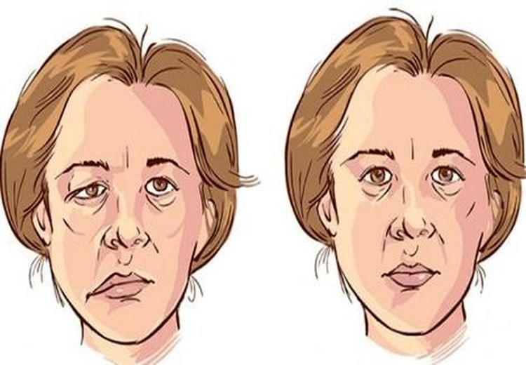 فلج یا اسپاسم نیمه صورت چیست و چطور درمان می‌شود؟