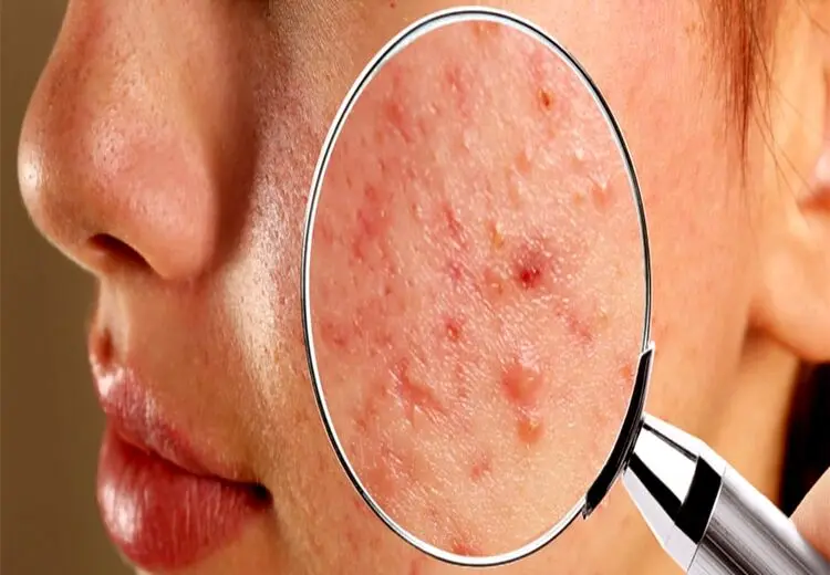 اگر از جوش‌های پوستی خسته شده‌اید این گیاهان چاره کار شما هستند