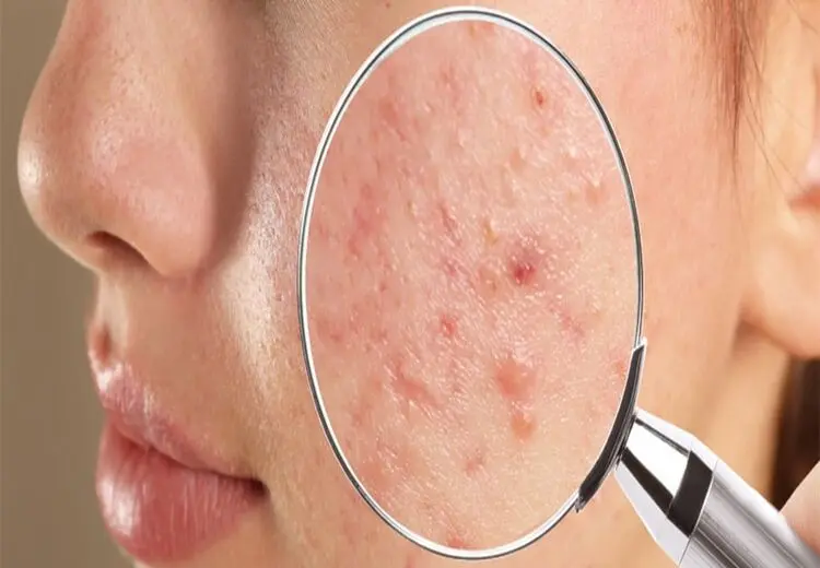 اگر از جوش‌های پوستی خسته شده‌اید این گیاهان چاره کار شما هستند