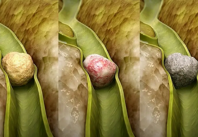 چرا زنان بیشتر از مردان دچار سنگ کیسه صفرا می‌شوند؟