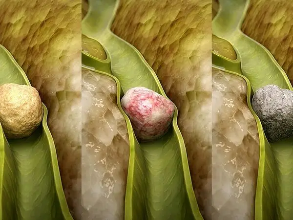 چرا زنان بیشتر از مردان دچار سنگ کیسه صفرا می‌شوند؟