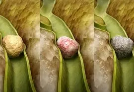 چرا زنان بیشتر از مردان دچار سنگ کیسه صفرا می‌شوند؟