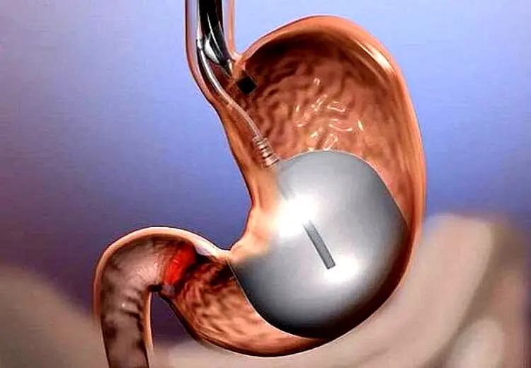 جراحی کاهش وزن از سلامت کبد محافظت می‌کند
