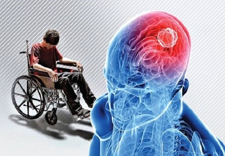 ام‌اس؛ بیماری جوانان با ۱۰ نشانه خاموش