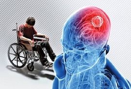 علائم اولیه بیماری ام اس چندین سال زودتر ظهور می‌کند