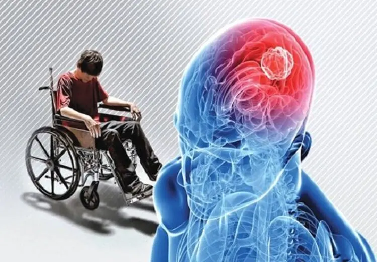 علائم اولیه بیماری ام اس چندین سال زودتر ظهور می‌کند