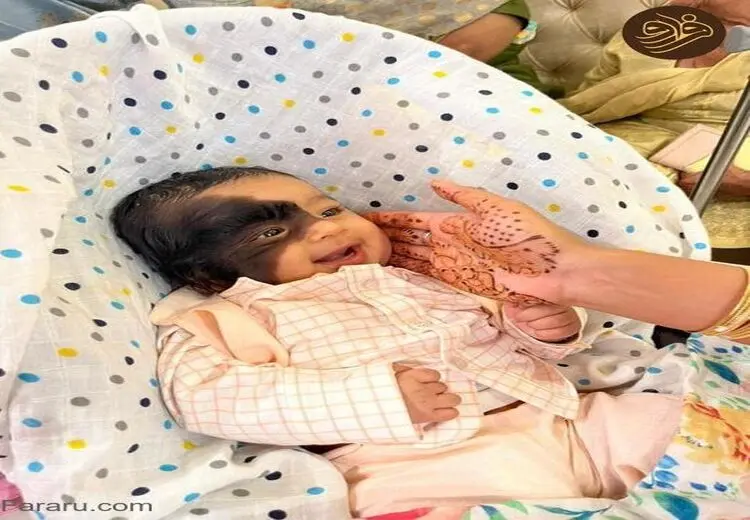 تصاویر کودکی با خال عجیب و مودار روی صورت