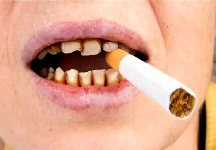 دندان سیگاری‌ها ۴ برابرِ افراد دیگر خراب می‌شود