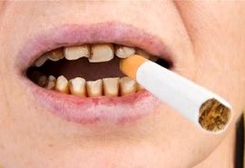 دندان سیگاری‌ها ۴ برابرِ افراد دیگر خراب می‌شود