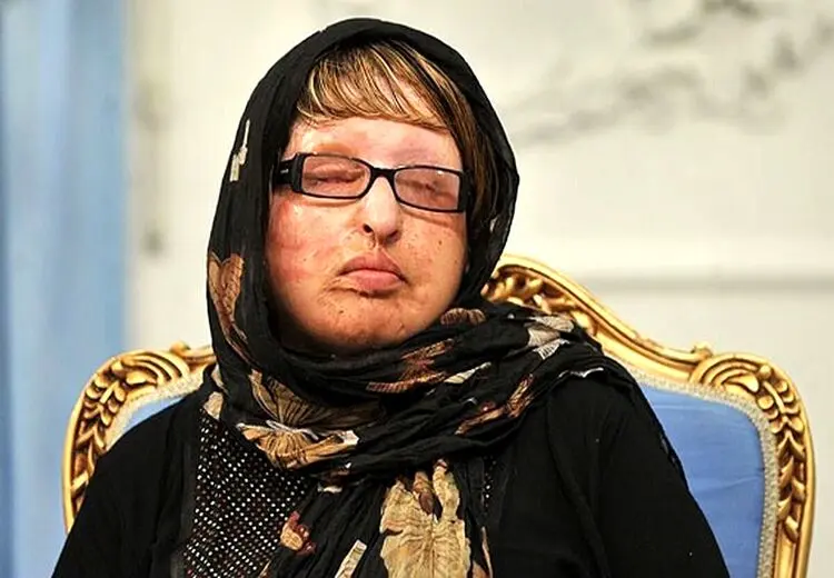 آمنه بهرامی؛ قربانی معروف اسیدپاشی بعد از ۱۸ سال دوباره شکایت کرد/ پشیمانم که بخشیدم!