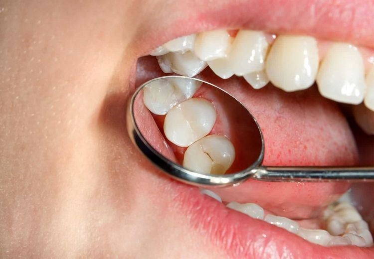 کرونا آمار پوسیدگی دندان را در ایران بالا برده است