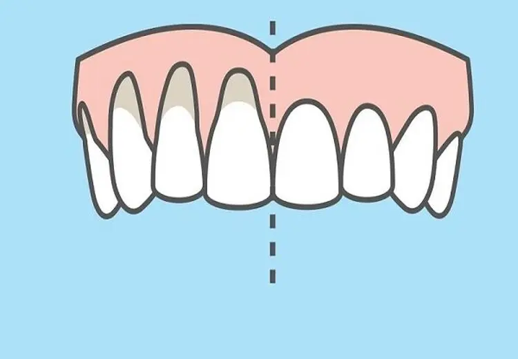 چرا دچار عقب رفتگی لثه می‌شویم؟