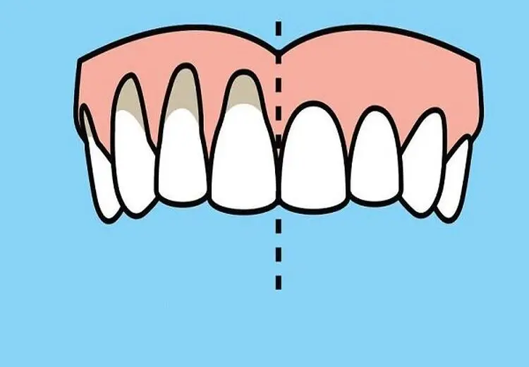 چرا دچار عقب رفتگی لثه می‌شویم؟