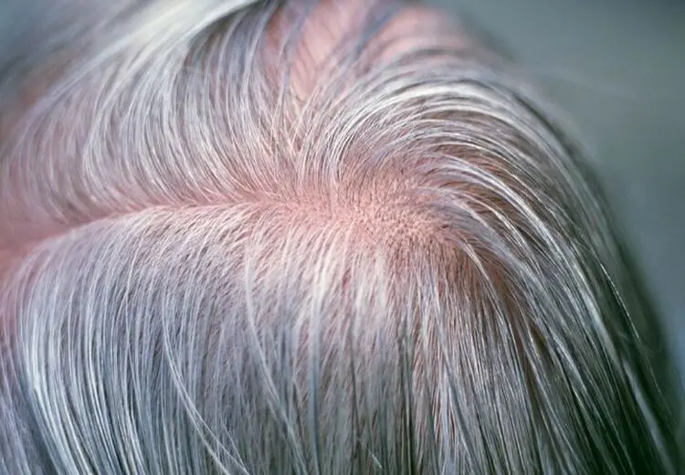 آیا می‌توان جلوی سفید شدن موها را گرفت؟/ علت سفیدی مو در نواحی شقیقه‌ها چیست؟