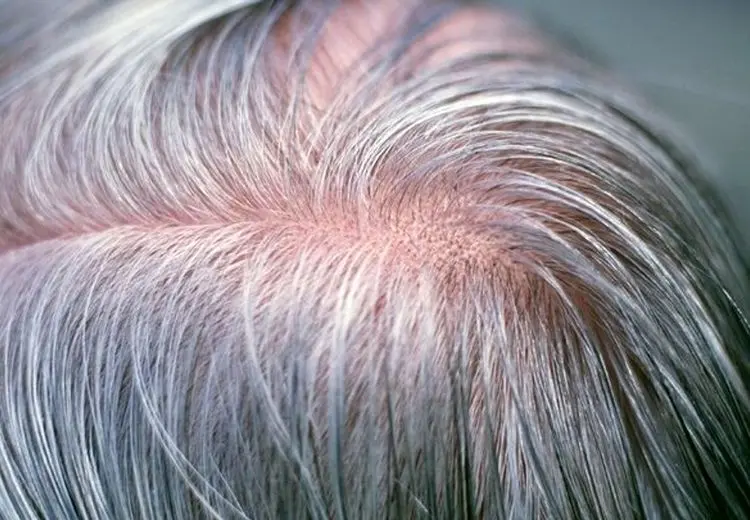 آیا می‌توان جلوی سفید شدن موها را گرفت؟/ علت سفیدی مو در نواحی شقیقه‌ها چیست؟