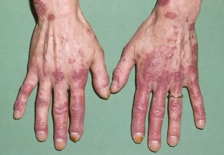 لوپوس در کودکان خطرناک‌تر و پیشرونده‌تر است/ ضرورت تشخیص زودهنگام