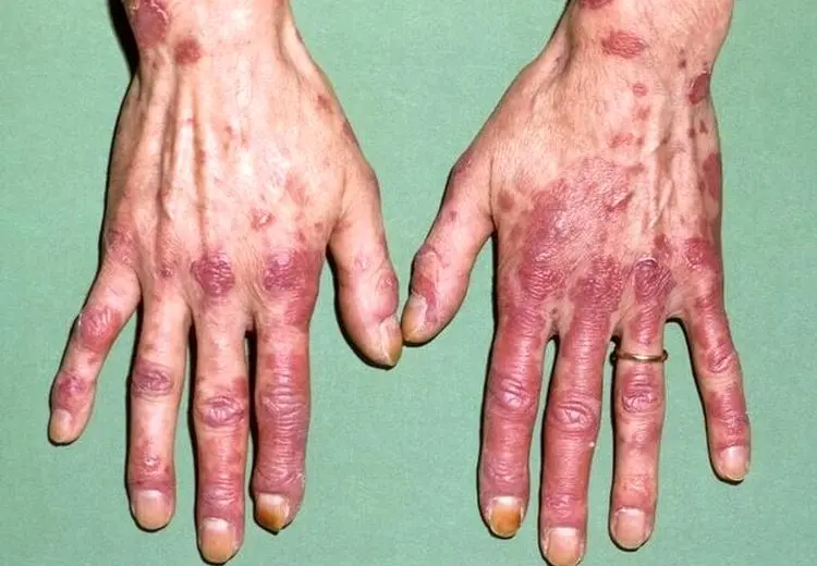 لوپوس در کودکان خطرناک‌تر و پیشرونده‌تر است/ ضرورت تشخیص زودهنگام