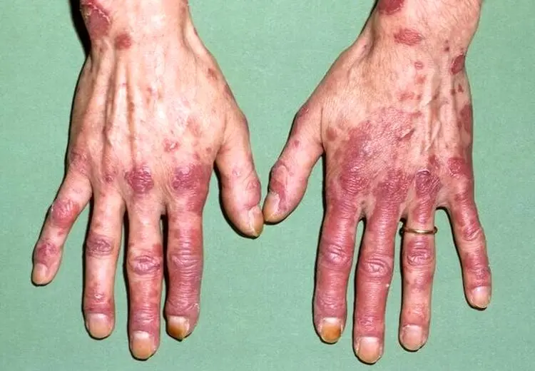 لوپوس در کودکان خطرناک‌تر و پیشرونده‌تر است/ ضرورت تشخیص زودهنگام