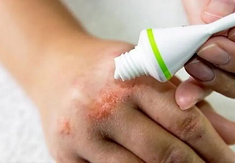 آلرژی‌های ناشی از محصولات آرایشی، چالشی جدی اما قابل پیشگیری