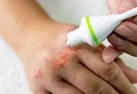 آلرژی‌های ناشی از محصولات آرایشی، چالشی جدی اما قابل پیشگیری