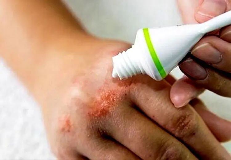 آلرژی‌های ناشی از محصولات آرایشی، چالشی جدی اما قابل پیشگیری