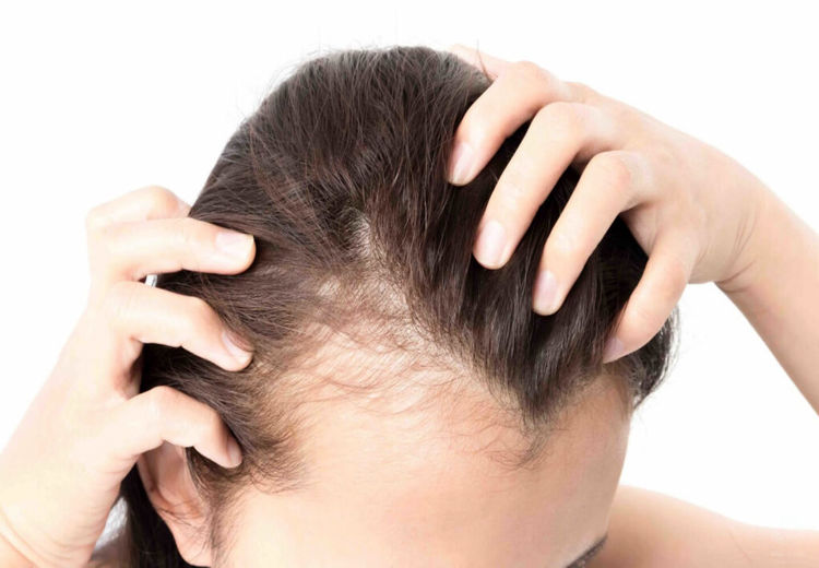 مهم ترین علت ریزش مو در مردان و زنان